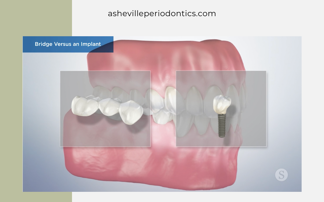 Video: Bridge Vs. Implant